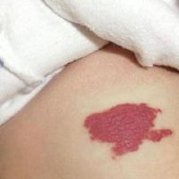 胎记隐藏着哪些寓意，解读你胎记的寓意